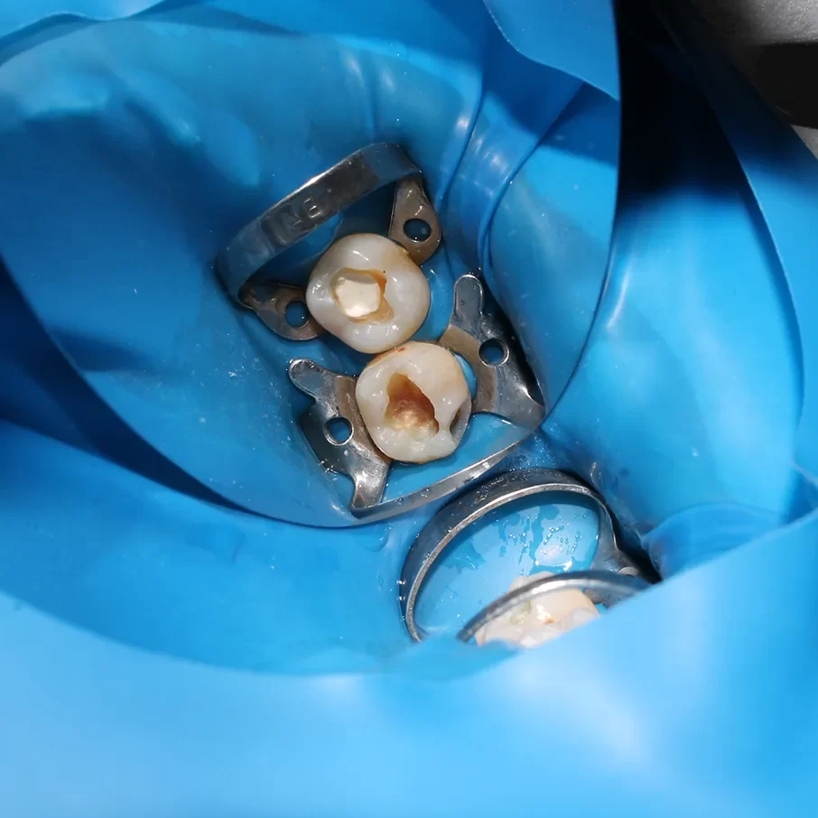 Dental Fillings