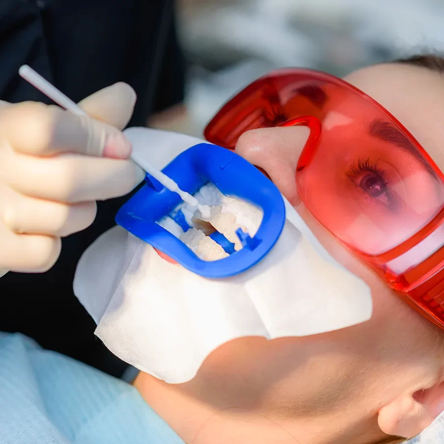 Fluoride Treatments