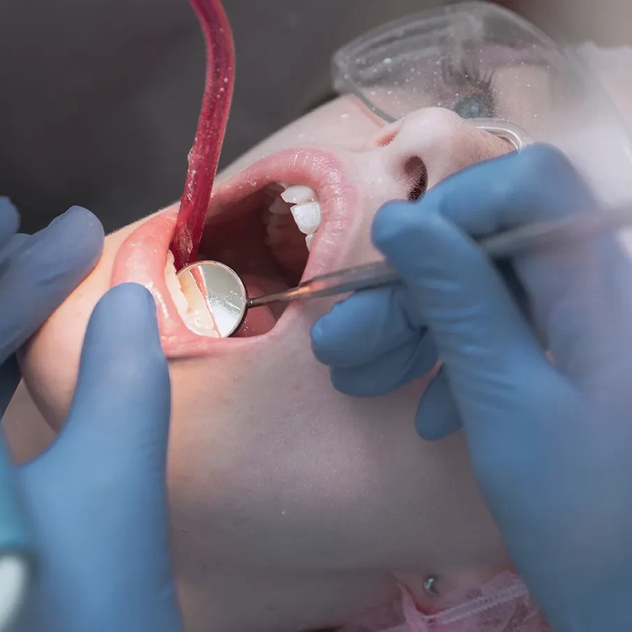 Root Canal Therapy